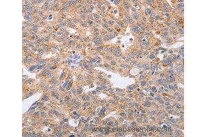 Immunohistochemistry of Human lung cancer using PPP1CB Polyclonal Antibody at dilution of 1:40 (PPP1CB antibody)