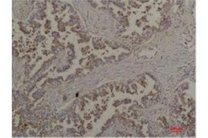 Immunohistochemistry (IHC) analysis of paraffin-embedded Human Lung Carcinoma using Flotillin-2 Rabbit Polyclonal Antibody diluted at 1:200. (Flotillin 2 antibody)