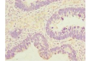 Immunohistochemistry of paraffin-embedded human ovarian cancer using ABIN7171132 at dilution of 1:100 (SYCE1 antibody  (AA 132-351))