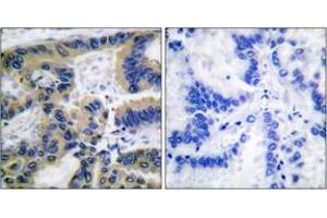 Immunohistochemistry analysis of paraffin-embedded human lung carcinoma tissue, using Caspase 7 (Cleaved-Asp198) Antibody. (Caspase 7 antibody  (Cleaved-Asp198))