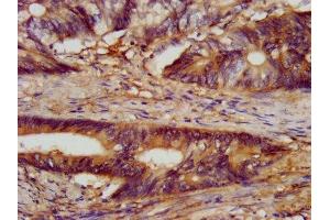 IHC image of ABIN7147493 diluted at 1:300 and staining in paraffin-embedded human colon cancer performed on a Leica BondTM system. (CLN5 antibody  (AA 42-181))