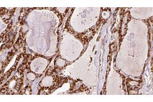 ABIN6266446 at 1/100 staining Human thyroid cancer tissue by IHC-P. (CD28 antibody  (C-Term))