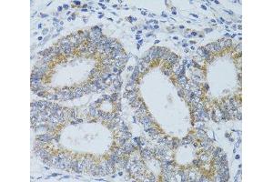 Immunohistochemistry of paraffin-embedded Human colon carcinoma using DNAJC19 Polyclonal Antibody at dilution of 1:100 (40x lens). (DNAJC19 antibody)