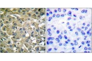 Immunohistochemistry analysis of paraffin-embedded human breast carcinoma tissue, using Keratin 18 (Ab-33) Antibody. (Cytokeratin 18 antibody  (AA 1-50))