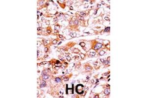 Formalin-fixed and paraffin-embedded human cancer tissue reacted with the primary antibody, which was peroxidase-conjugated to the secondary antibody, followed by AEC staining. (p21 antibody  (pThr57))