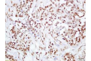 Formalin-fixed and paraffin embedded human lung carcinoma labeled with Rabbit Anti-PI3 Kinase p110 beta(Ser1070) Polyclonal Antibody, Unconjugated  at 1:200 followed by conjugation to the secondary antibody and DAB staining