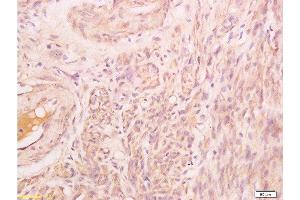 Formalin-fixed and paraffin embedded human endometrium carcinoma labeled with Rabbit Anti Phospho-Talin (Ser425) Polyclonal Antibody, Unconjugated  at 1:200 followed by conjugation to the secondary antibody and DAB staining (Talin antibody  (pSer425))