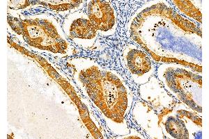 ABIN6257299 and ABIN6275373 at 1/100 staining Human ovarian cancer by IHC-P. (KCNK17 antibody)