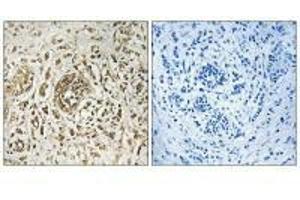 Immunohistochemistry analysis of paraffin-embedded human breast carcinoma tissue, using CIB2 antibody. (CIB2 antibody)