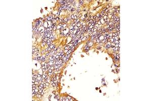 (ABIN387816 and ABIN2843905) staining EGFR in human lung adenocarcinoma sections by Immunohistochemistry (IHC-P - paraformaldehyde-fixed, paraffin-embedded sections). (EGFR antibody)
