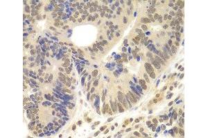 Immunohistochemistry of paraffin-embedded Human colon carcinoma using LHX4 Polyclonal Antibody at dilution of 1:100 (40x lens).