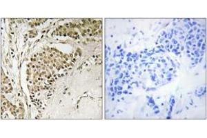 Immunohistochemistry analysis of paraffin-embedded human breast carcinoma tissue, using NOM1 Antibody. (NOM1 antibody  (AA 661-710))