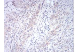 Immunohistochemical analysis of paraffin-embedded cervical cancer tissues using RND3 mouse mAb with DAB staining. (RND3 antibody  (AA 104-241))
