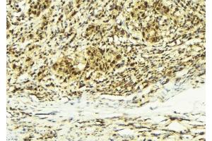 ABIN6279208 at 1/100 staining Human breast cancer tissue by IHC-P. (CABIN1 antibody  (Internal Region))