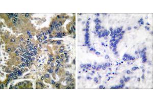 Cl-peptide - +Immunohistochemical analysis of paraffin-embedded human lung carcinoma tissue using Caspase 1 (Cleaved-Asp210) antibody. (Caspase 1 antibody  (Cleaved-Asp210))