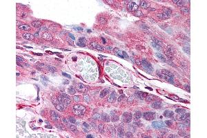 Anti-PLA2G3 antibody IHC of human colon carcinoma. (PLA2G3 antibody  (Internal Region))