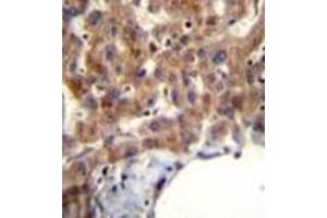 Immunohistochemistry analysis in formalin fixed and paraffin embedded human liver tissue reacted with MBNL2 Antibody (C-term) followed which was peroxidase conjugated to the secondary antibody and followed by AB staining. (MBNL2 antibody  (C-Term))