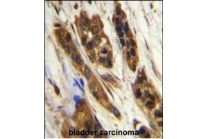 SNR27 Antibody (Center) (ABIN655835 and ABIN2845250) immunohistochemistry analysis in formalin fixed and paraffin embedded human bladder carcinoma followed by peroxidase conjugation of the secondary antibody and DAB staining. (SNRNP27 antibody  (AA 69-98))