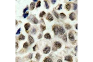 Immunohistochemistry of paraffin-embedded human lung carcinoma using Phospho-HDAC8-S39 antibody (ABIN2988043). (HDAC8 antibody  (pSer39))