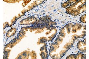 ABIN6263112 and ABIN6266890 at 1/100 staining Human prostate cancer by IHC-P. (MLK4 antibody  (C-Term))