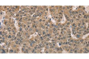 Immunohistochemistry of paraffin-embedded Human liver cancer tissue using DACH2 Polyclonal Antibody at dilution 1:40 (DACH2 antibody)
