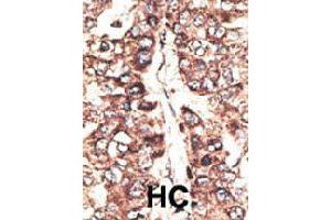 Formalin-fixed and paraffin-embedded human hepatocellular carcinoma tissue reacted with MAGEA11 polyclonal antibody  , which was peroxidase-conjugated to the secondary antibody, followed by DAB staining. (MAGEA11 antibody  (N-Term))
