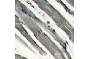 IHC analysis of FFPE human hepatocarcinoma stained with LRRK2 antibody (LRRK2 antibody  (AA 878-909))