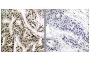 Immunohistochemical analysis of paraffin- embedded human breast carcinoma tissue using NF-κB p105/p50 (phospho-Ser337) antibody (E011017). (NFKB1 antibody  (pSer337))