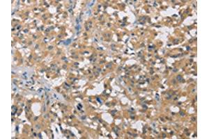 The image on the left is immunohistochemistry of paraffin-embedded Human thyroid cancer tissue using ABIN7129065(CST2 Antibody) at dilution 1/50, on the right is treated with fusion protein. (CST2 antibody)