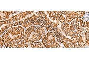 Immunohistochemistry of paraffin-embedded Human thyroid cancer tissue using NPC2 Polyclonal Antibody at dilution of 1:80(x200) (NPC2 antibody)