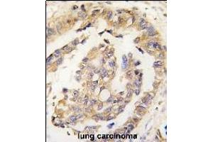 Formalin-fixed and paraffin-embedded human lung carcinoma tissue reacted with Olfm1 Antibody (N-term) (ABIN389177 and ABIN2839340) , which was peroxidase-conjugated to the secondary antibody, followed by DAB staining. (Olfactomedin 1 antibody  (N-Term))