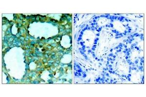Immunohistochemical analysis of paraffin-embedded human breast carcinoma tissue using PAK1(Phospho-Thr212) Antibody(left) or the same antibody preincubated with blocking peptide(right). (PAK1 antibody  (pThr212))