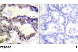 Immunohistochemical analysis of paraffin-embedded human lung carcinoma tissue using CASP2 polyclonal antibody . (Caspase 2 antibody  (Ser140))