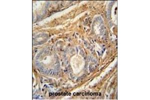 PCOTH antibody (Center) (ABIN654598 and ABIN2844298) immunohistochemistry analysis in formalin fixed and paraffin embedded human prostate carcinoma followed by peroxidase conjugation of the secondary antibody and DAB staining.