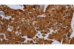 Immunohistochemistry of paraffin-embedded Human prostate cancer tissue using ENTPD7 Polyclonal Antibody at dilution 1:60 (ENTPD7 antibody)