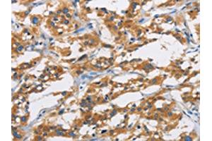 The image is immunohistochemistry of paraffin-embedded Human thyroid cancer tissue using ABIN7130969(SAR1B Antibody) at dilution 1/20. (SAR1B antibody)