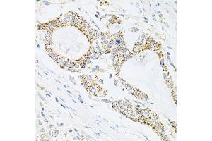 Immunohistochemistry of paraffin-embedded human gastric cancer using IRS1 antibody (ABIN5970075) at dilution of 1/100 (40x lens). (IRS1 antibody)