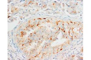 Immunohistochemical staining of OPCML on formalin fixed, paraffin embedded human mammary cancer with OPCML polyclonal antibody .