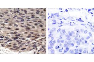 P-Peptide - +Immunohistochemical analysis of paraffin-embedded human breast carcinoma tissue using FKHRL1 (phospho-Ser253) antibody. (eIF4EBP1 antibody  (pThr36))