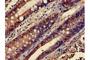 Immunohistochemistry of paraffin-embedded human colon cancer using ABIN7172843 at dilution of 1:100 (RHOA antibody  (AA 1-191))