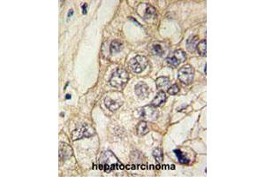 Formalin-fixed and paraffin-embedded human hepatocellular carcinoma tissue reacted with CDH6 polyclonal antibody , which was peroxidase-conjugated to the secondary antibody, followed by DAB staining. (CDH6 antibody  (C-Term))