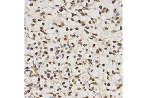 Immunohistochemistry of paraffin-embedded human kidney cancer tissue using H3R17me2a antibody at dilution of 1:200 (x400 lens) (Histone 3 antibody  (H3R17me2a))