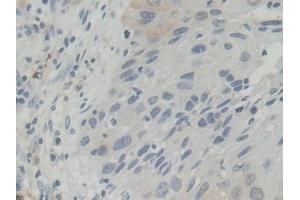 Detection of BLVRB in Human Lung cancer Tissue using Polyclonal Antibody to Biliverdin Reductase B (BLVRB)