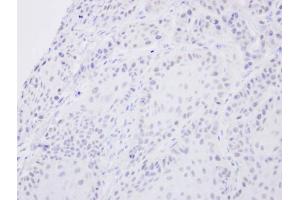 IHC-P Image Immunohistochemical analysis of paraffin-embedded Cal27 xenograft, using SENP2, antibody at 1:500 dilution. (SENP2 antibody  (N-Term))