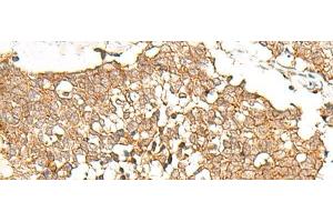 Immunohistochemistry of paraffin-embedded Human lung cancer tissue using PRLHR Polyclonal Antibody at dilution of 1:70(x200) (PRLHR antibody)