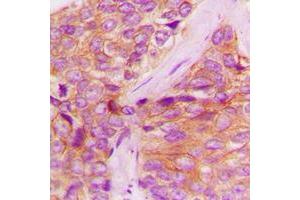 Immunohistochemical analysis of JAK1 (pY1022) staining in human breast cancer formalin fixed paraffin embedded tissue section.