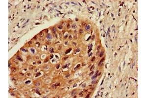 Immunohistochemistry of paraffin-embedded human cervical cancer using ABIN7176497 at dilution of 1:100