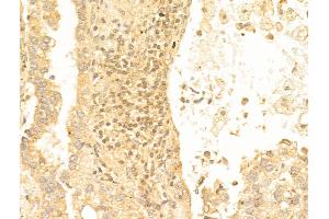 ABIN6259708 and ABIN6267079 at 1/100 staining Human lung cancer by IHC-P. (FOXO1 antibody  (acLys294))