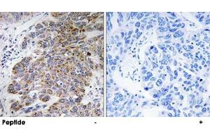Immunohistochemistry analysis of paraffin-embedded human lung carcinoma tissue, using CHST10 polyclonal antibody . (CHST10 antibody)