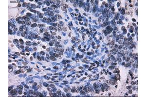 Immunohistochemical staining of paraffin-embedded Adenocarcinoma of colon tissue using anti-RPA2 mouse monoclonal antibody. (RPA2 antibody)